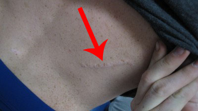 Scar Face, Leg or Arm